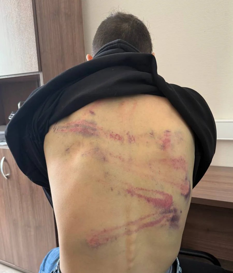 Bruises on Ostanin’s back. Photo: Eva Merkacheva /Telegram
